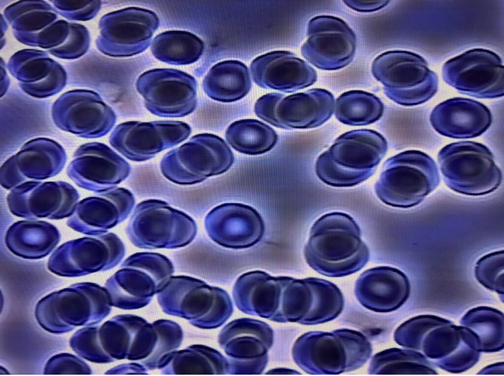 clumping rbc's
